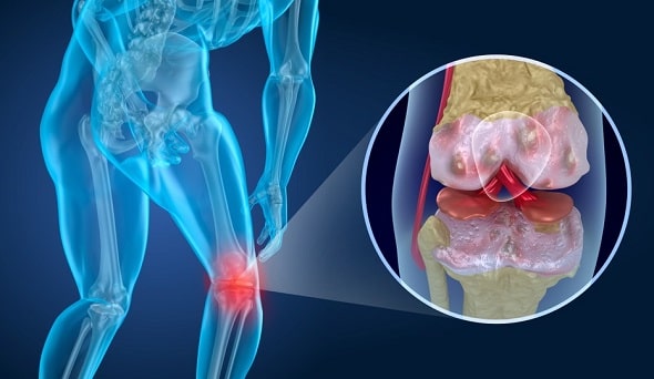 meniscus-klachten-knie-informatie-brace